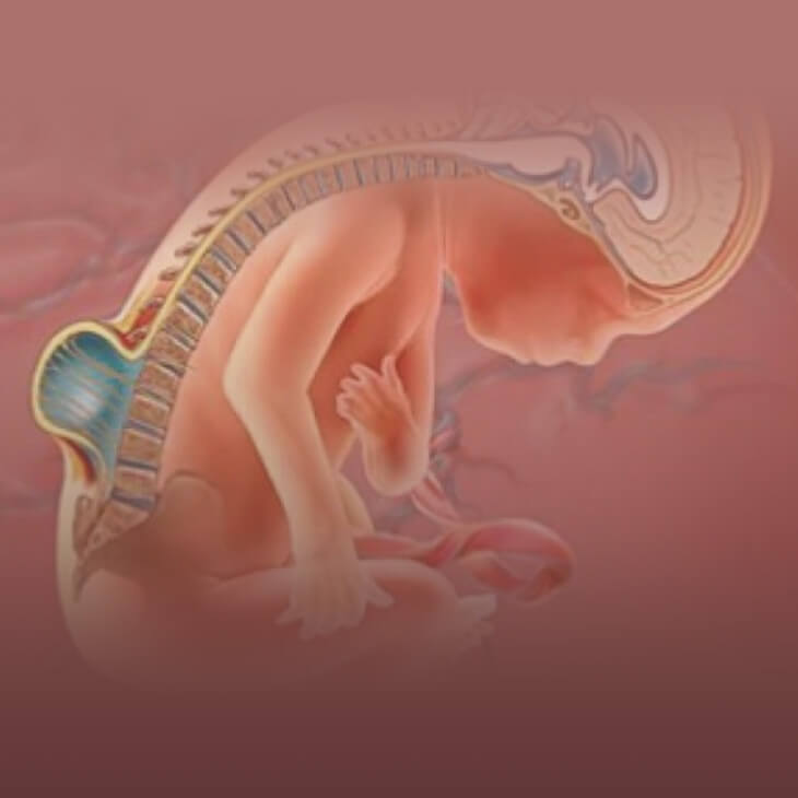 Diagnóstico na Gravidez Meningomielocele - Tratamento e Cura da Espinha Bífida Aberta no Feto e Bebê